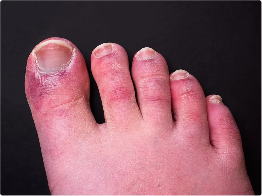 Chilblains